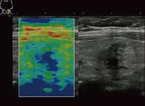 Strain Elastography компрессионная эластография